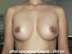 plastic-surgery-breast-augmentation 